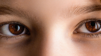 Strabismus_Condition