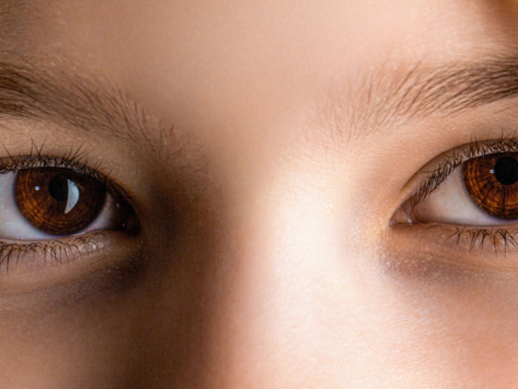 Strabismus_Condition