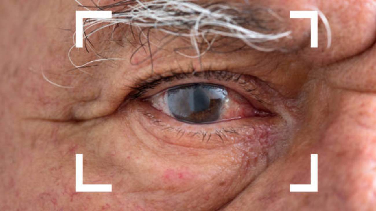Cataract surgery